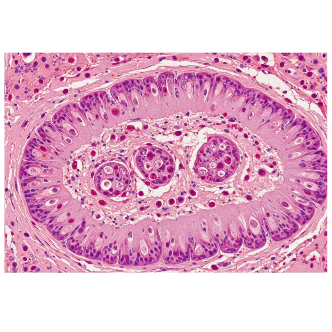 FECAL CALPROTECTIN CONCENTRATIONS IN CATS WITH CHRONIC ENTEROPATHIES